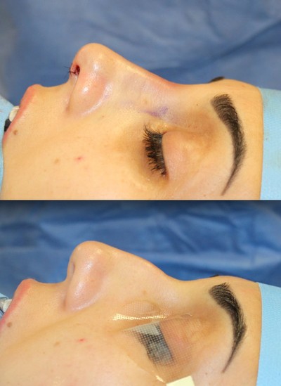 Rhinoplasty before and after