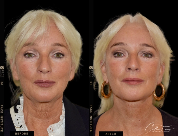 before and after deep plane facelift 4