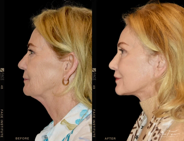 before and after deep plane facelift 0