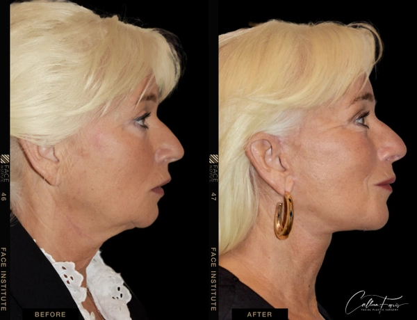 before and after deep plane facelift 3