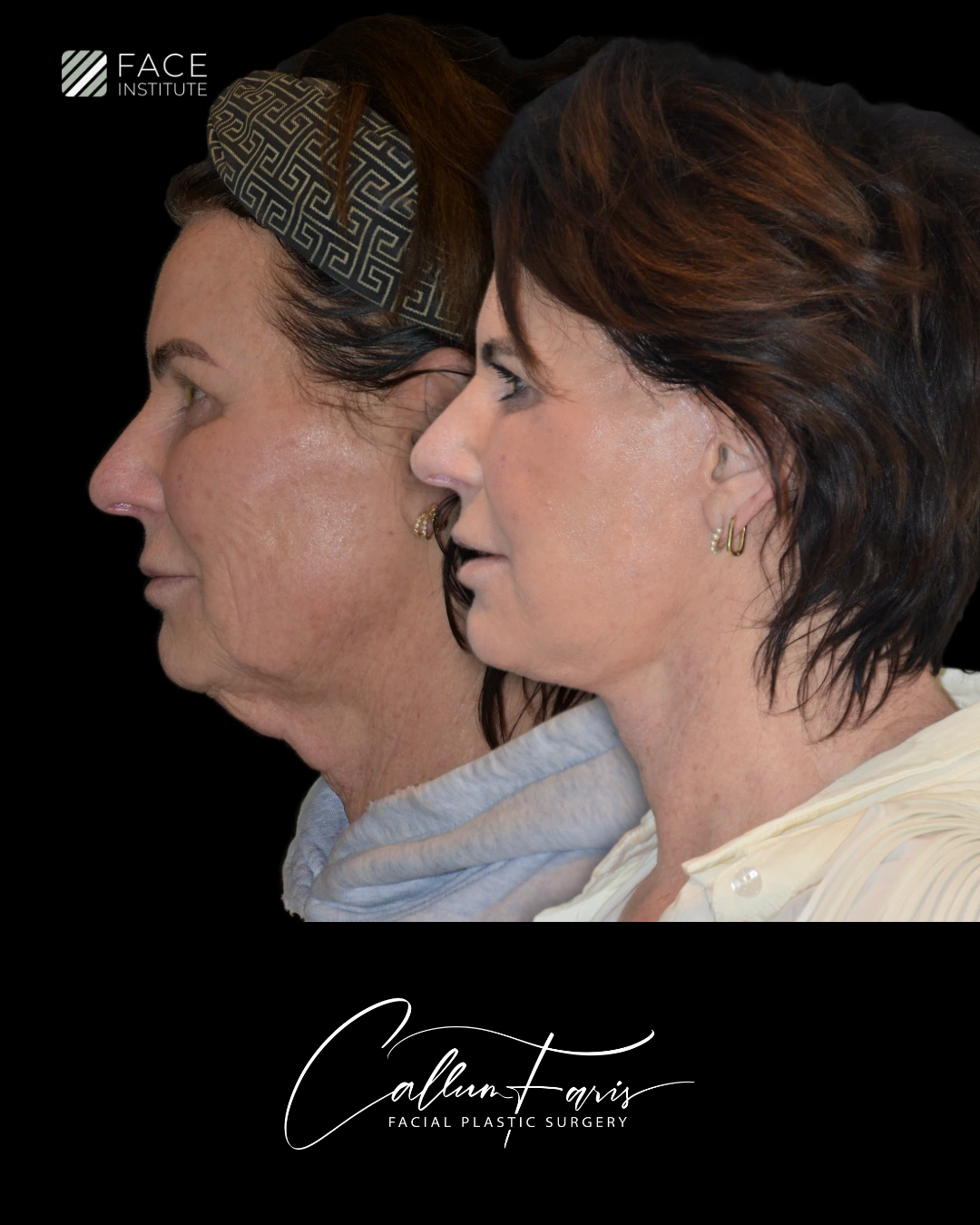 Before and after deep plane facelift