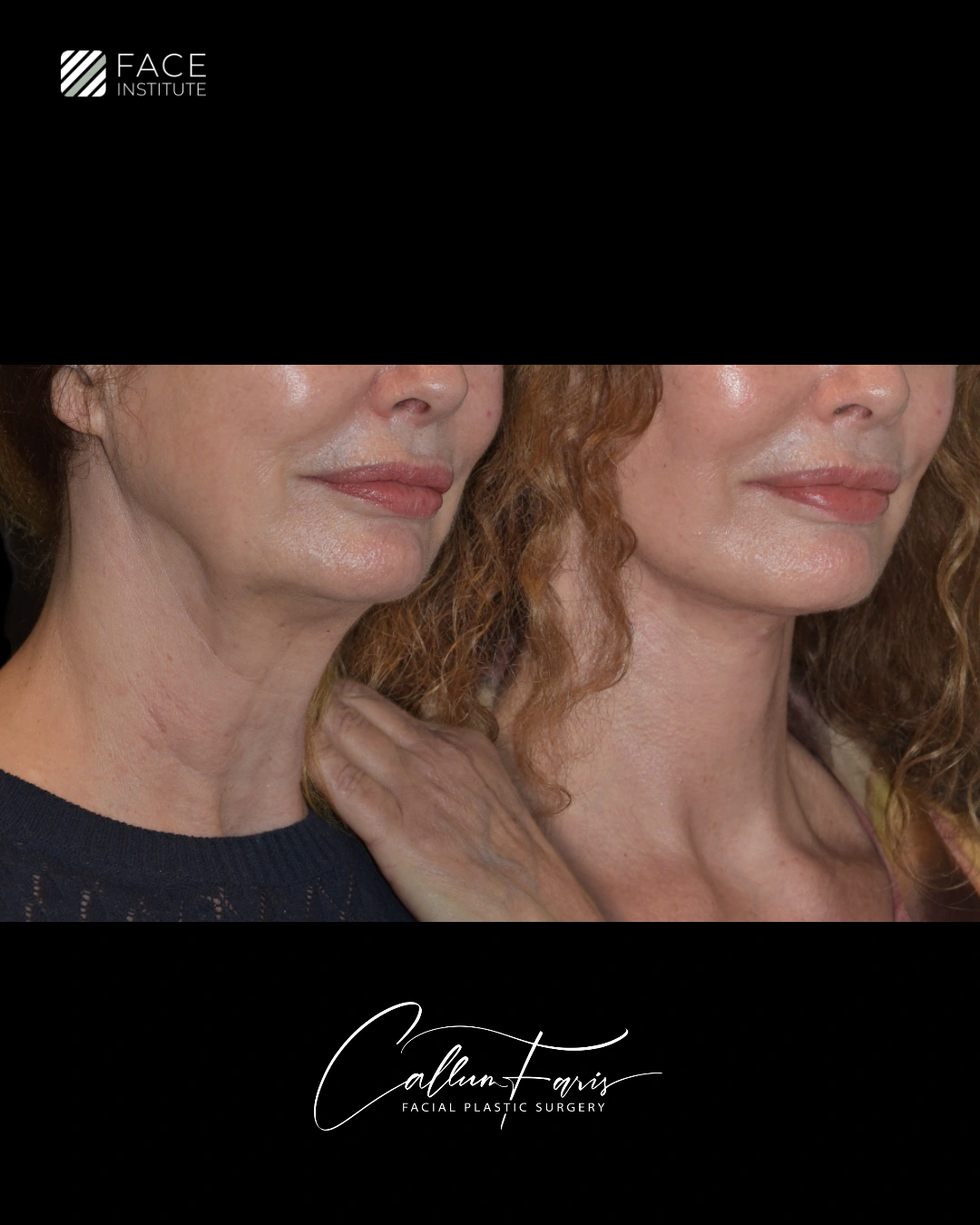 Before and after deep plane facelift