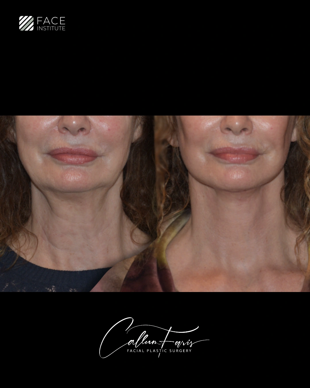 Before and after deep plane facelift