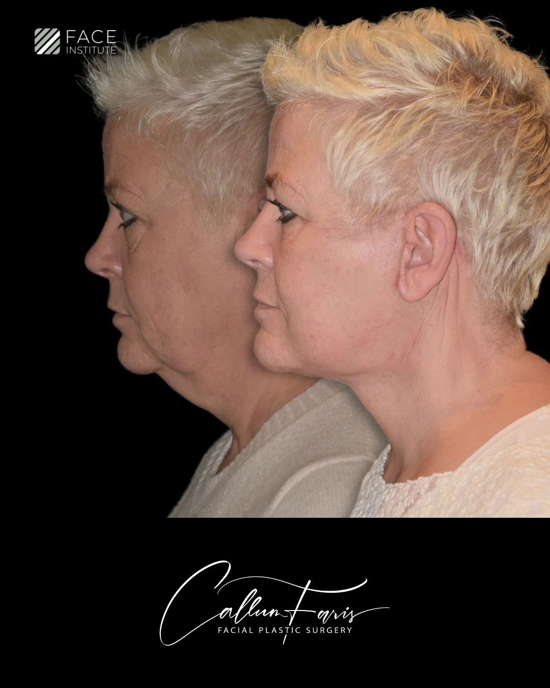 Before and after deep plane facelift