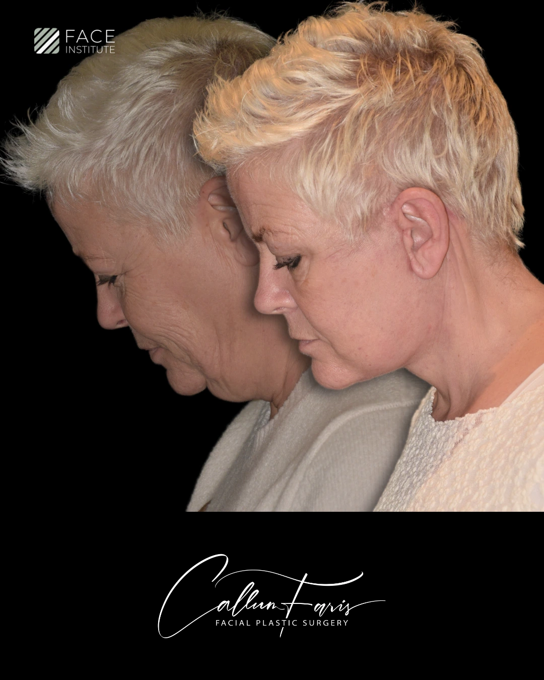 Before and after deep plane facelift