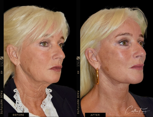 before and after deep plane facelift