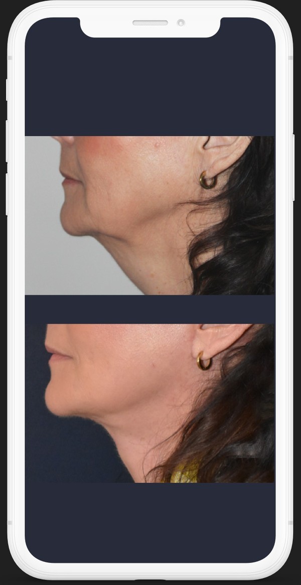 Before and after facelift
