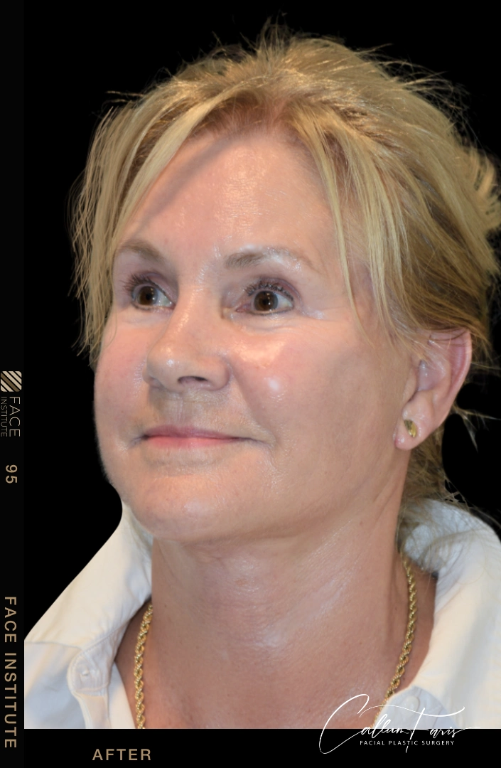 Deep plane facelift example 3 after