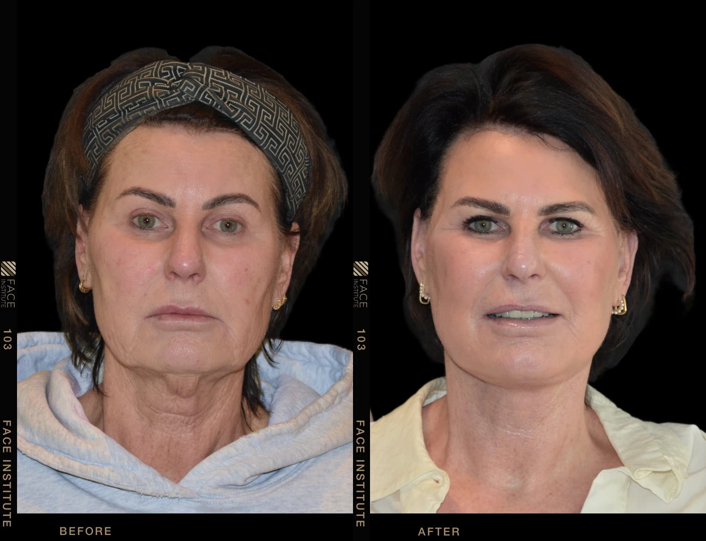 Extended Deep Plane Face & Neck Lift — before & after