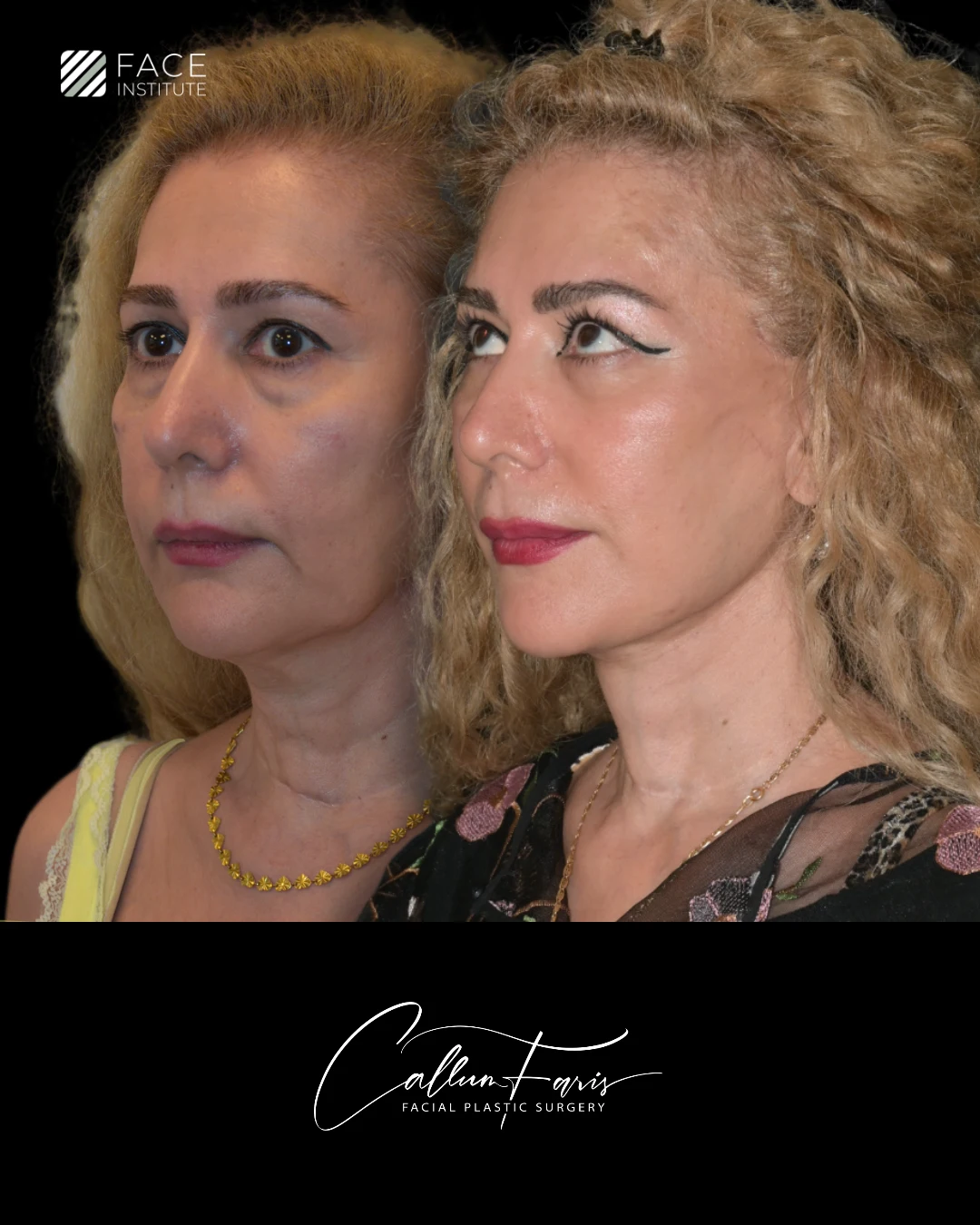 Before and After Example 2