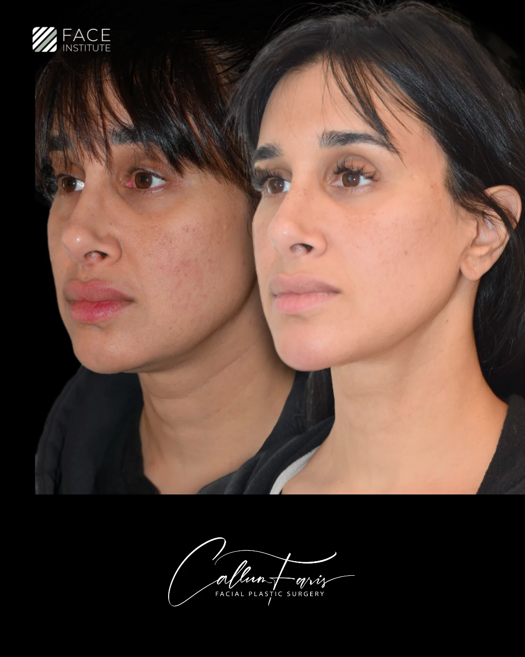 Before and After Example 3