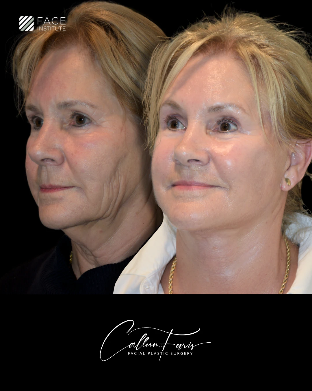 Before and After Example 4