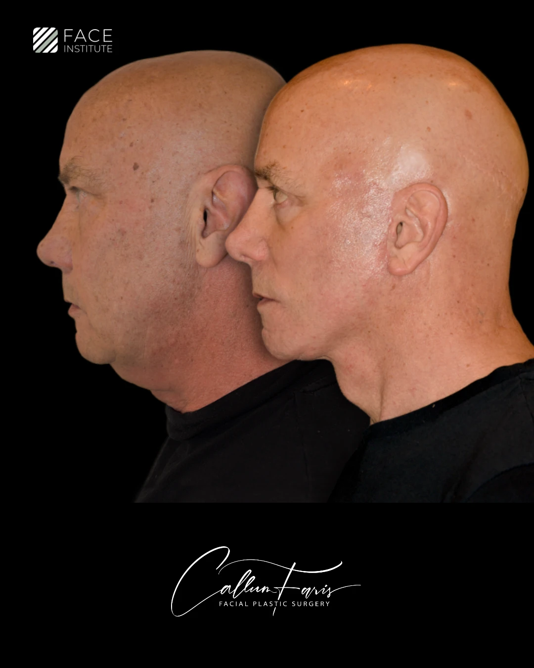 Before and After Example 5