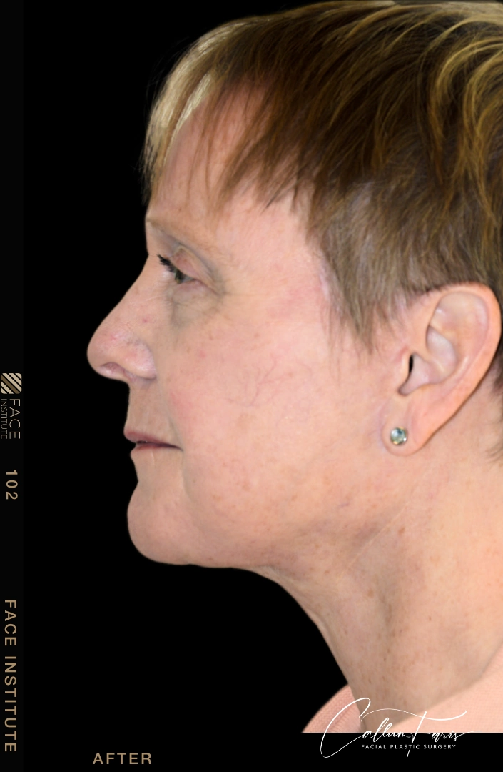 Deep plane facelift example 4 after