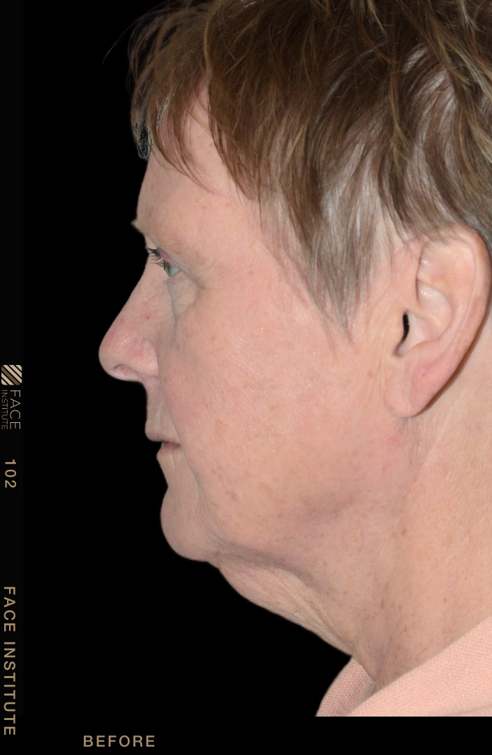Deep plane facelift example 4 before