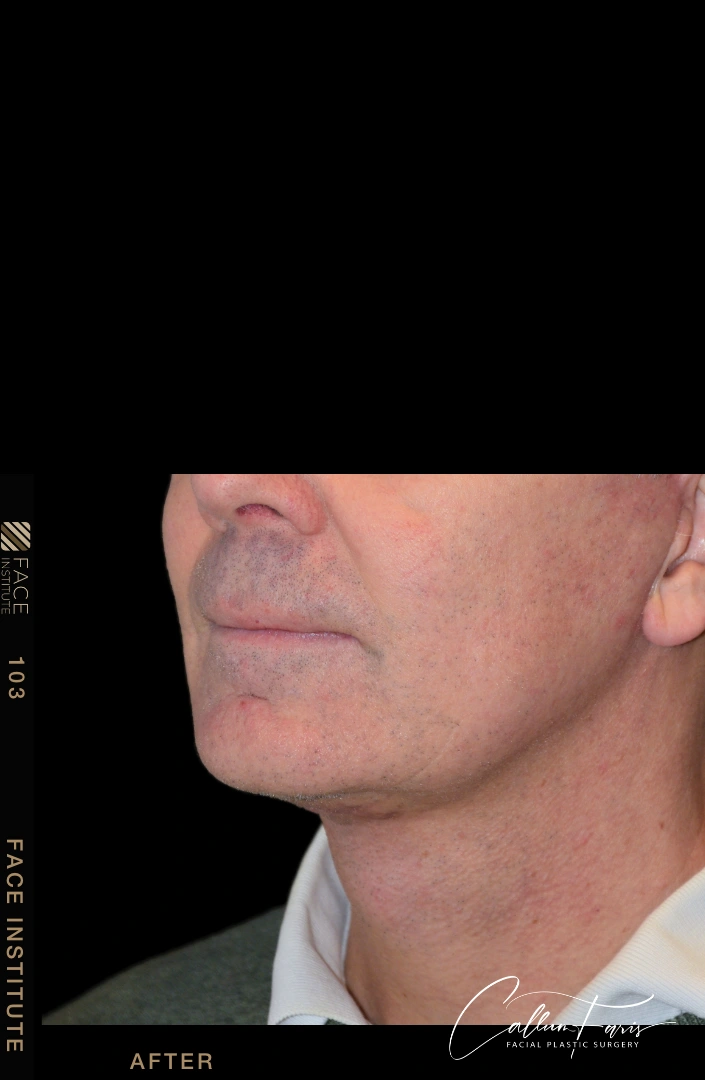 Male facelift 3/4 left view before