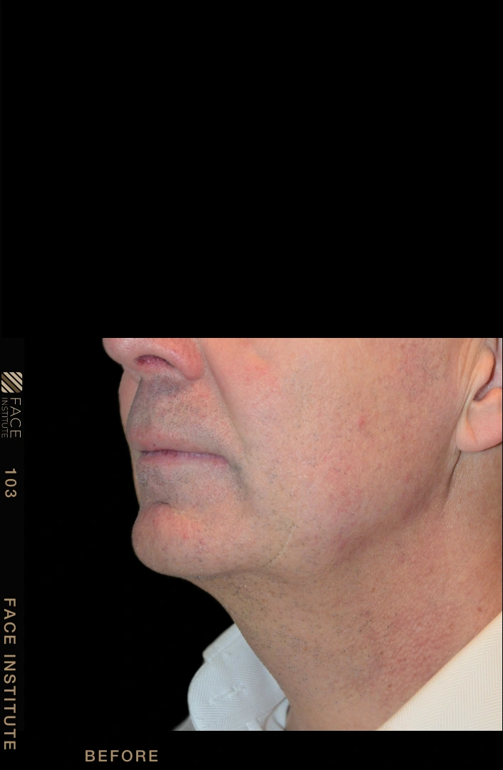 Male facelift 3/4 left view after
