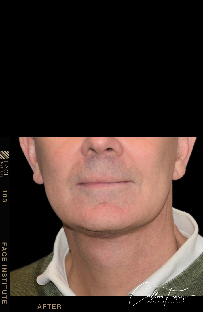 Male facelift 3/4 left view before