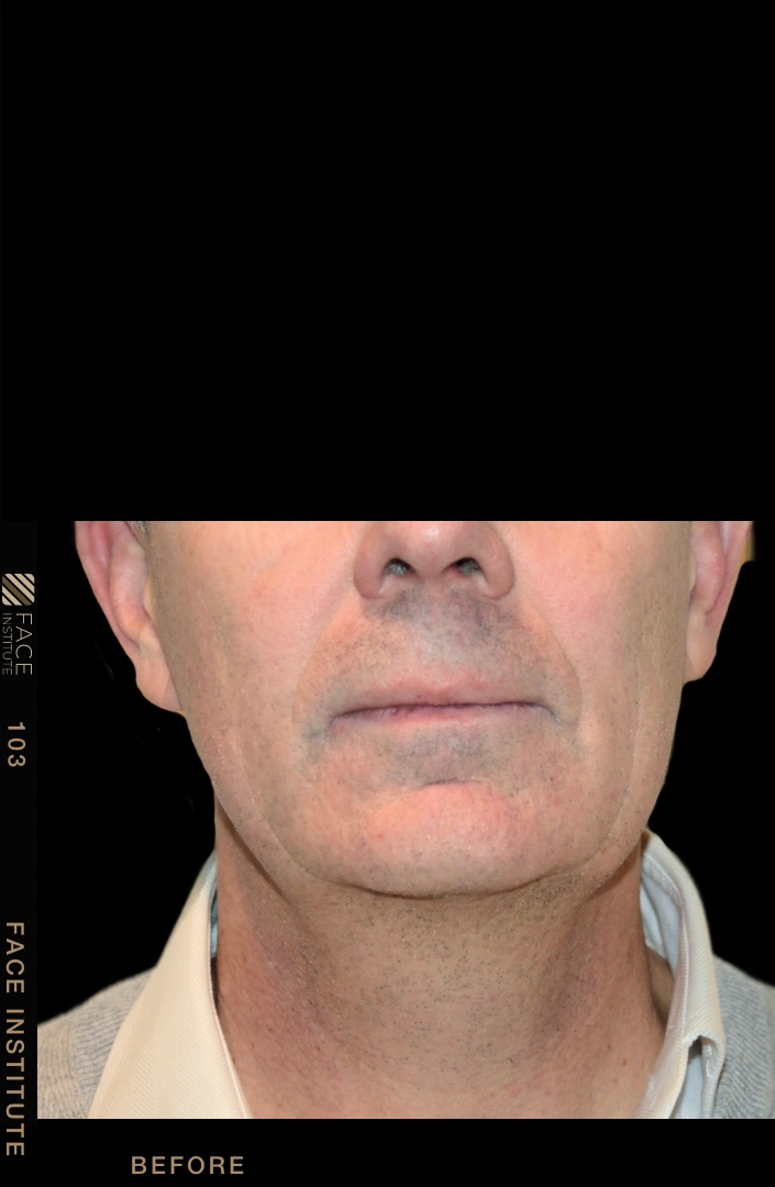 Male facelift 3/4 left view after