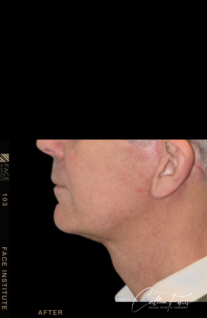 Male facelift 3/4 left view before