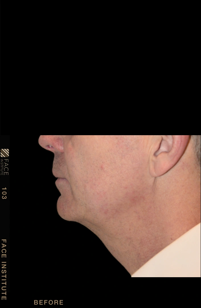 Male facelift 3/4 left view after