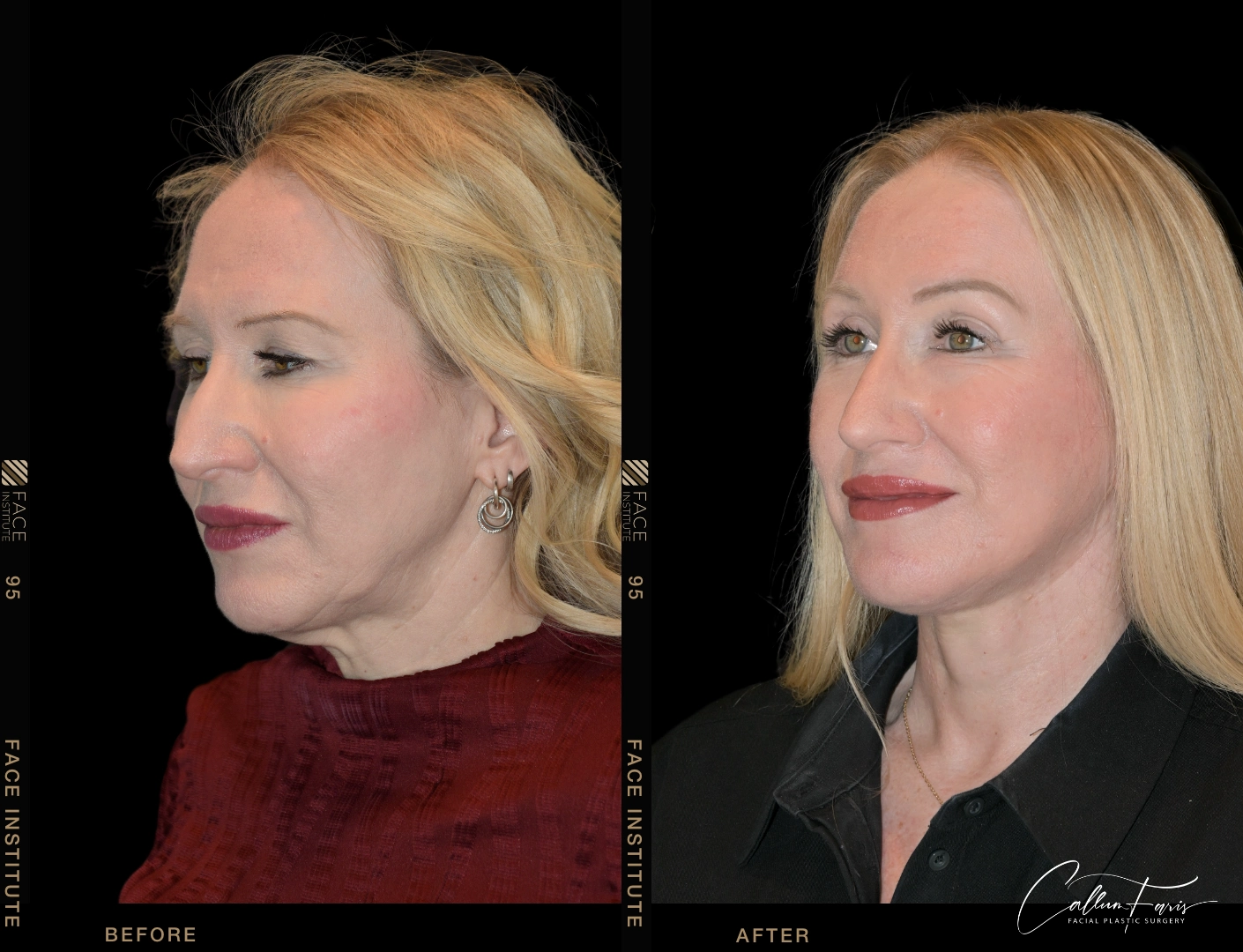 Extended deep-plane facelift & deep neck lift — before & after