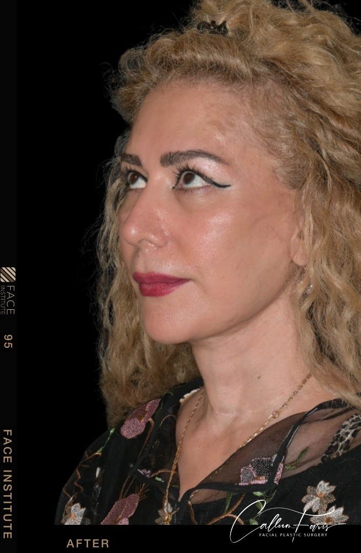 Deep plane facelift example 4 after