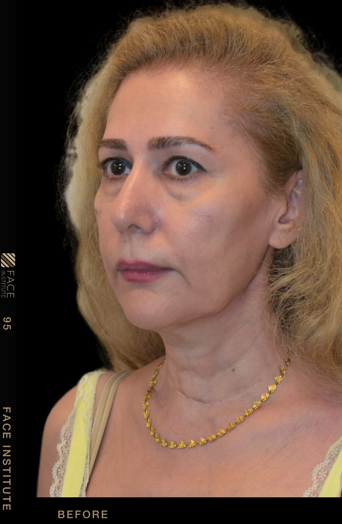 Deep plane facelift example 4 before