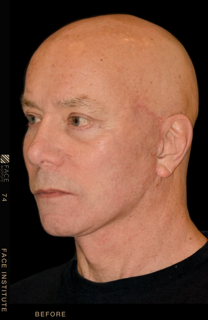 Male facelift 3/4 left view after