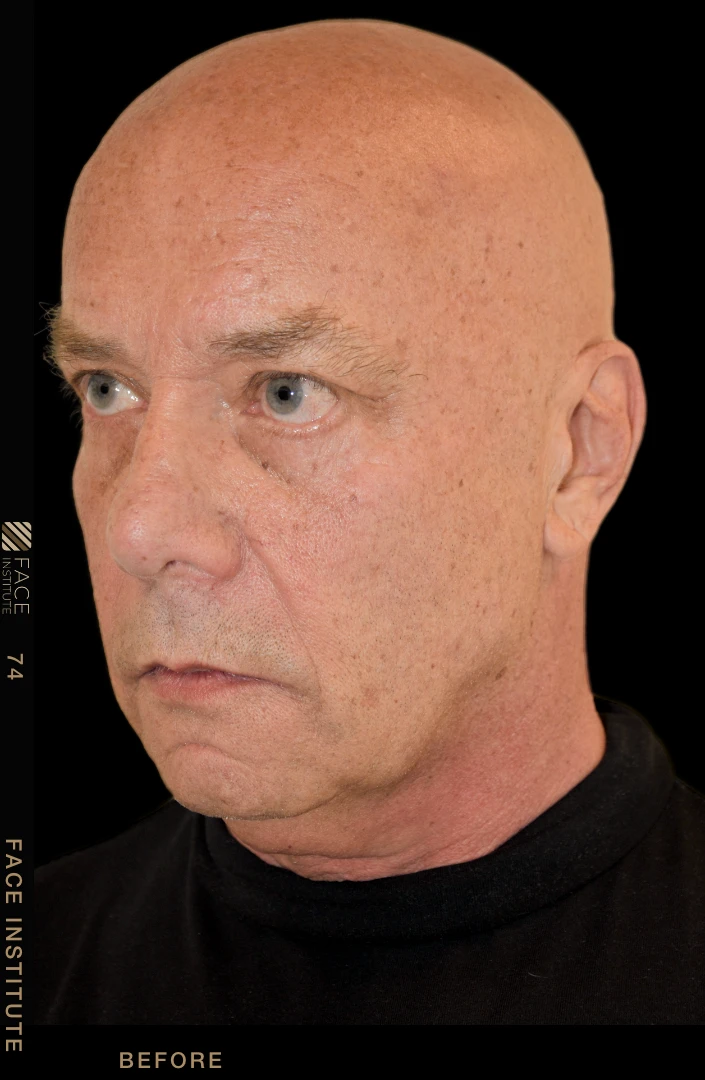 Male facelift 3/4 left view before