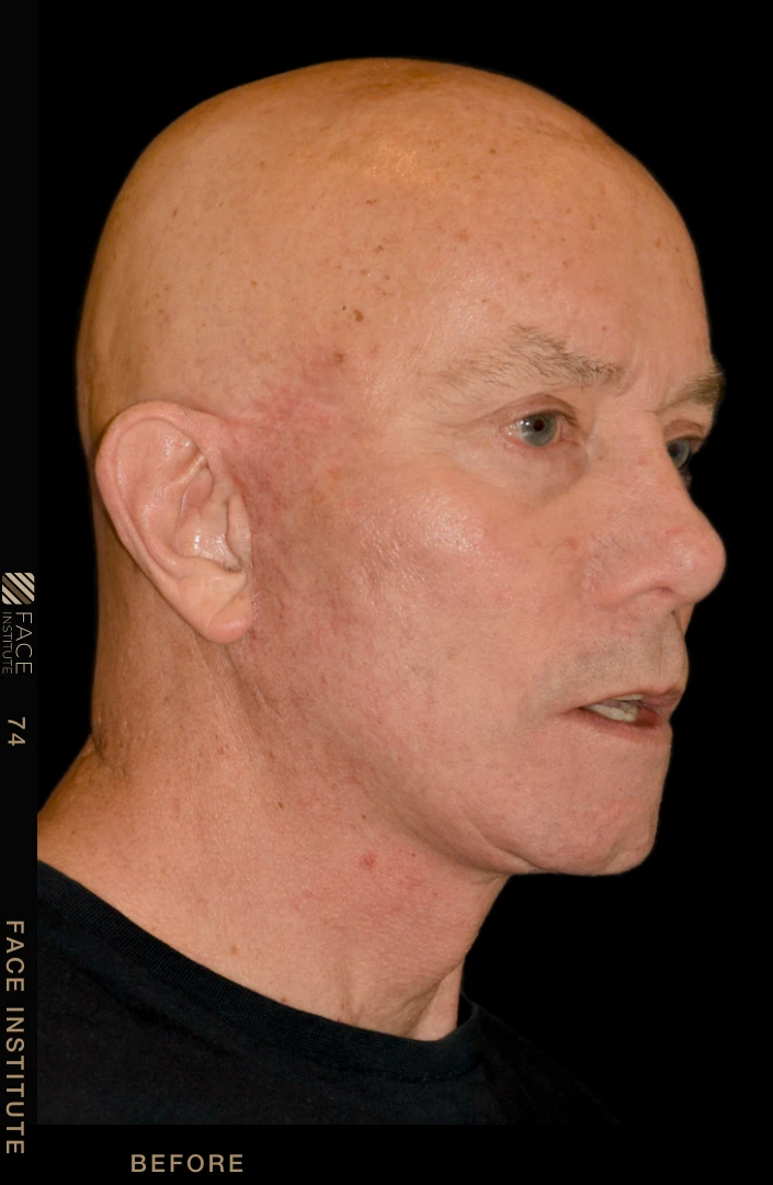 Male facelift 3/4 right view after