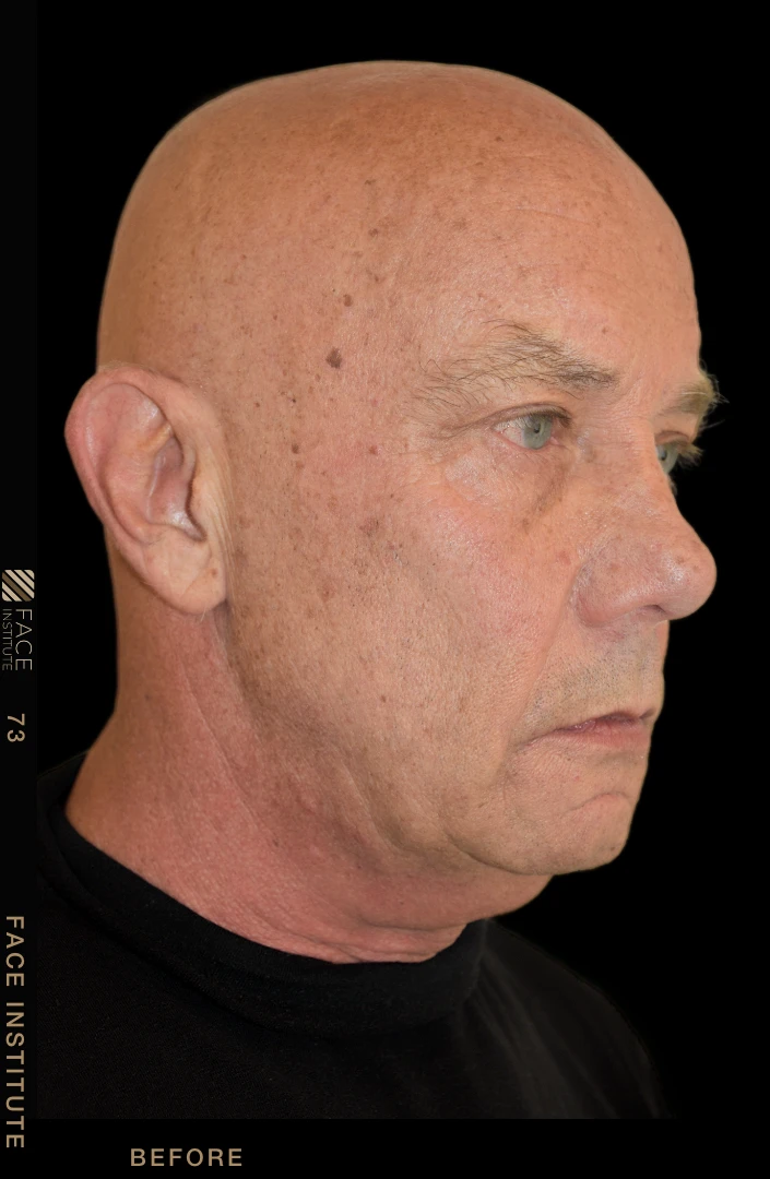 Male facelift 3/4 right view before