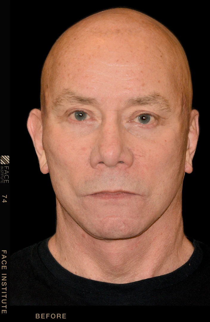 Male facelift front view after