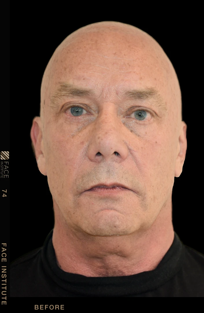 Male facelift front view before