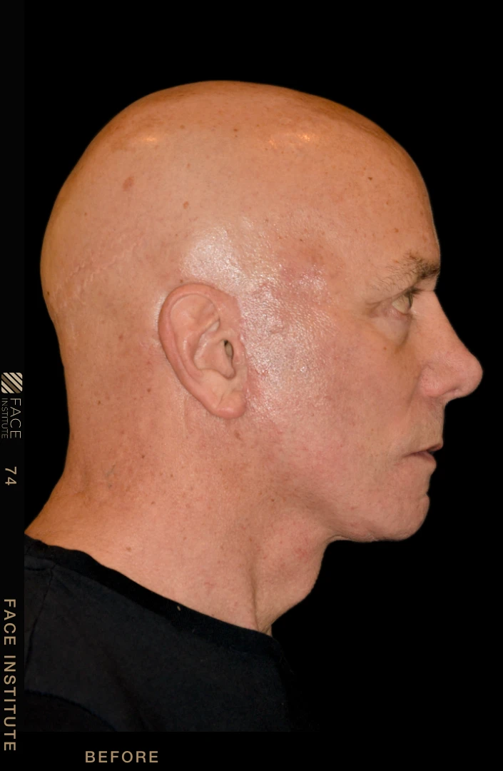 Male facelift lateral view after