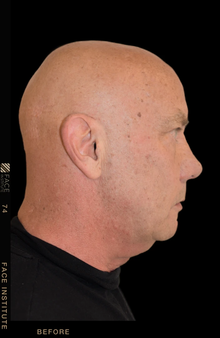 Male facelift lateral view before