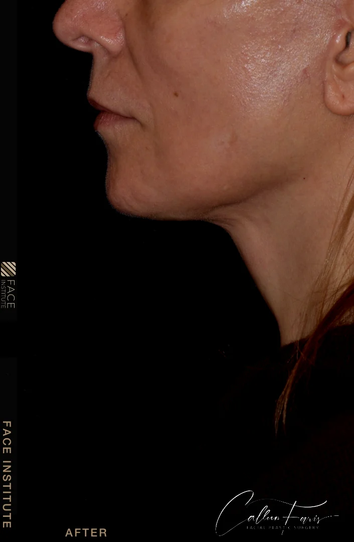Deep plane facelift example 5 after