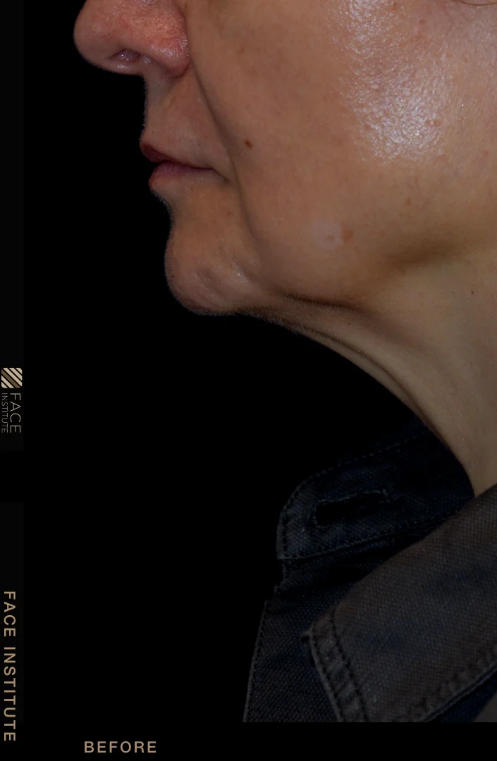 Deep plane facelift example 5 before